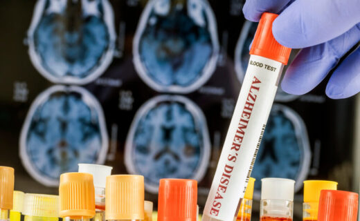 Organoidi cerebrali per la ricerca sull'Alzheimer
