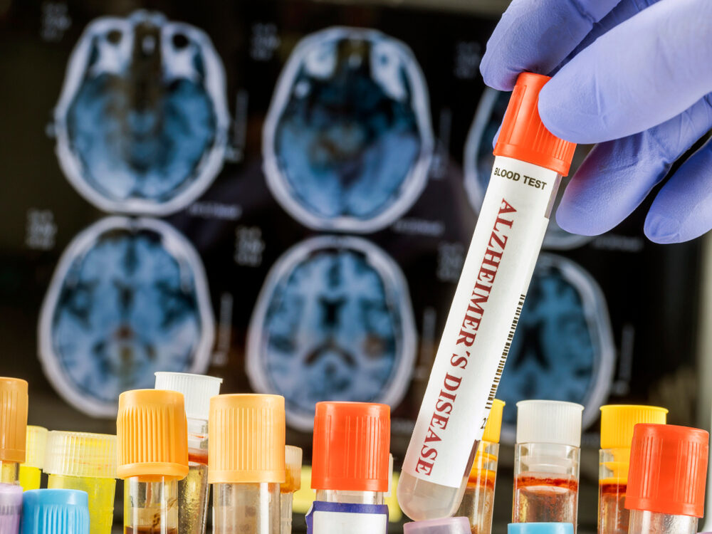 Organoidi cerebrali per la ricerca sull'Alzheimer